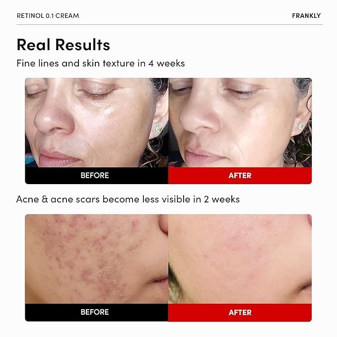 Frankly - Retinol 0.1 Wrinkle Repair Cream