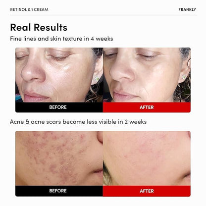 Frankly - Retinol 0.1 Wrinkle Repair Cream