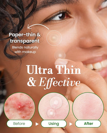 Troubless Invisible Pimple Spot Patch The Classic