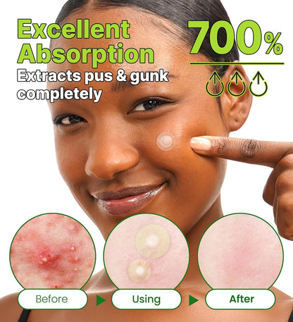 Troubless Invisible Pimple Spot Patch The Red Correct